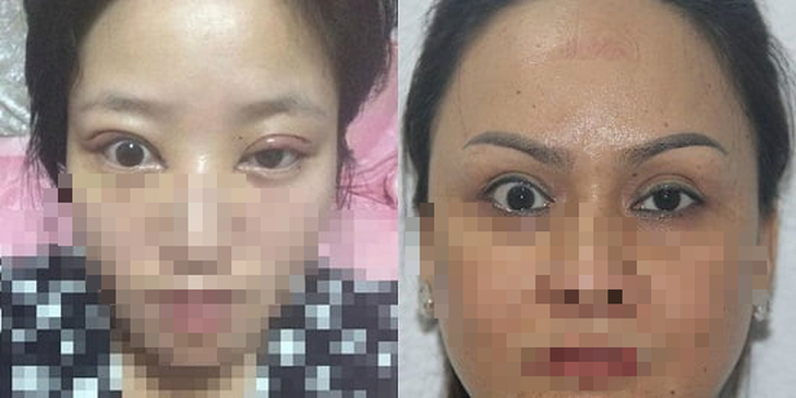 Cắt mí mắt – đừng vì mí to lại lo mất ngủ - Ảnh 1. Cắt mí mắt – đừng vì mí to lại lo mất ngủ - Ảnh 1.