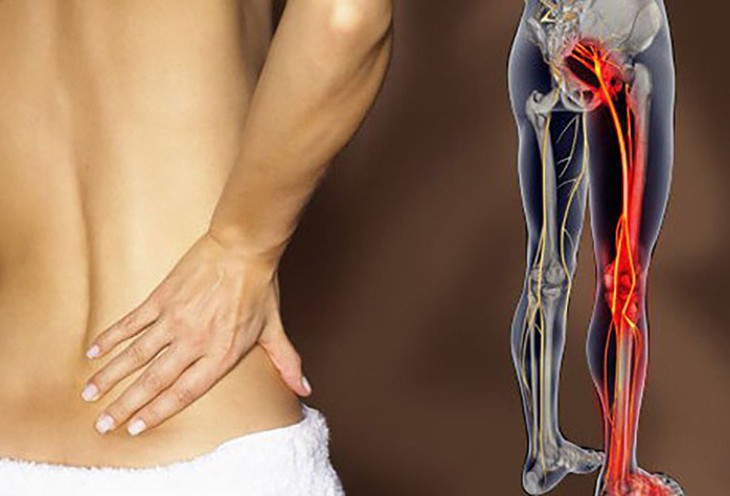 Có nên phẫu thuật khi bị đau thần kinh tọa? - Ảnh 2. Có nên phẫu thuật khi bị đau thần kinh tọa? - Ảnh 2.