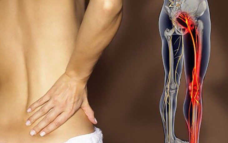 Có nên phẫu thuật khi bị đau thần kinh tọa?
