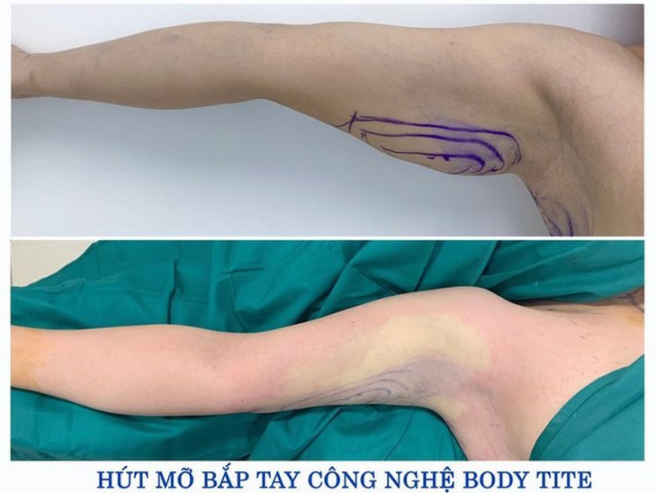 Người phụ nữ bị nhiễm trùng nặng sau khi tiêm Botox thon gọn bắp tay tại Spa - Ảnh 3.