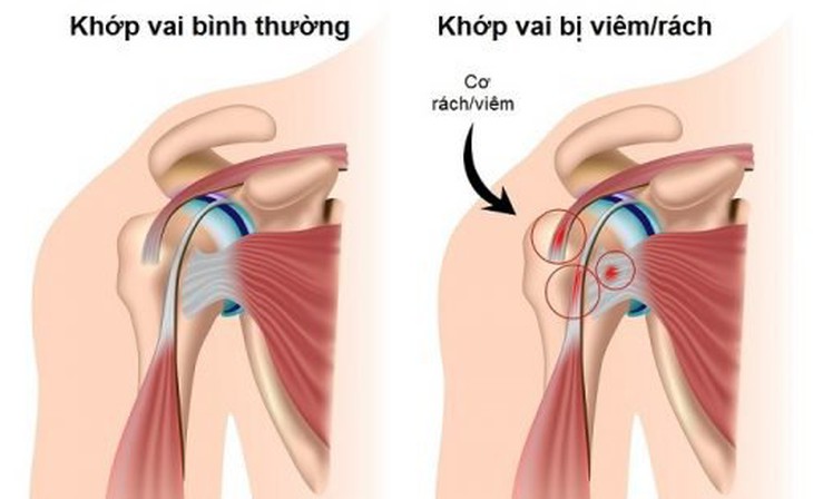 Viêm gân cơ nhị đầu là tình trạng viêm ở đầu dài gân cơ nhị đầu. Đây cũng là nguyên nhân phổ biến gây ra chứng đau vai. Ảnh minh họa Viêm gân cơ nhị đầu là tình trạng viêm ở đầu dài gân cơ nhị đầu. Đây cũng là nguyên nhân phổ biến gây ra chứng đau vai. Ảnh minh họa
