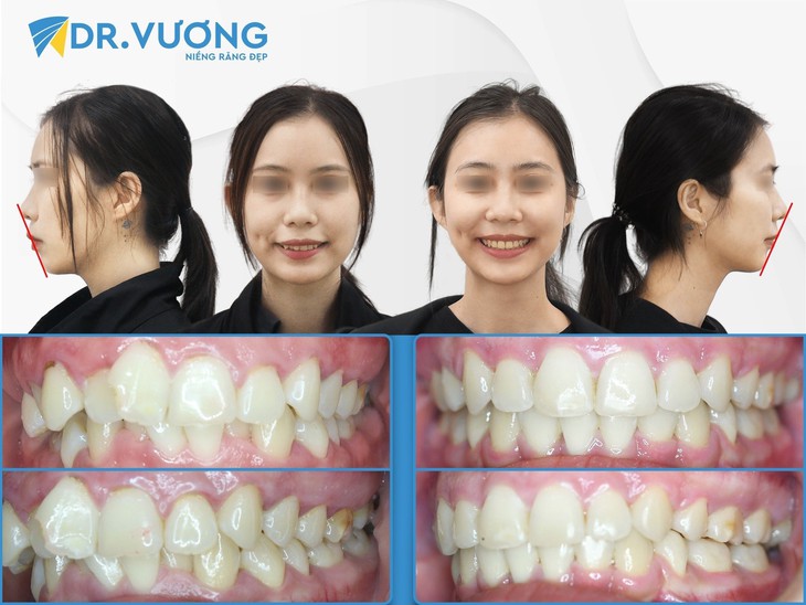 Niềng răng tại Nha khoa Dr. Vương có tốt không? - Ảnh 3. Niềng răng tại Nha khoa Dr. Vương có tốt không? - Ảnh 3.