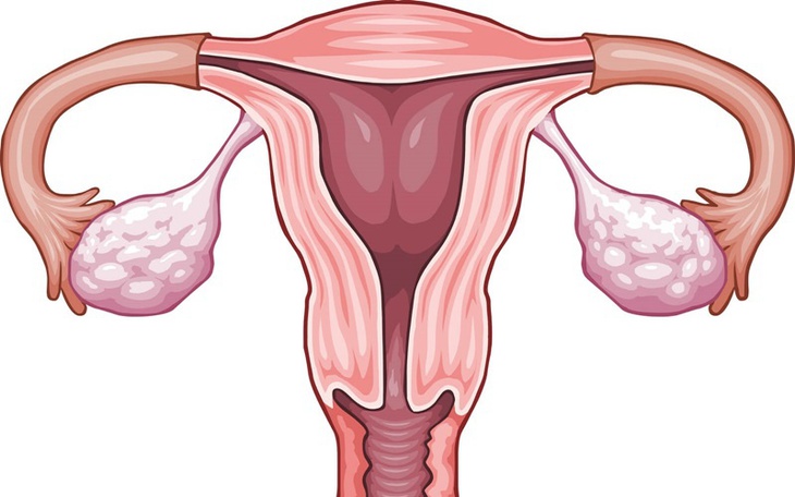 Nguyên nhân tiềm ẩn gây đau buồng trứng cần lưu ý