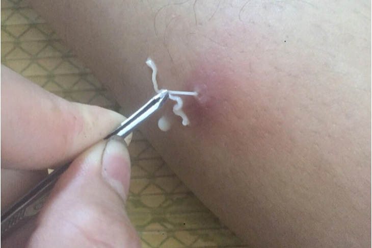 Giun rồng dài hàng mét trong cơ thể, bác sĩ cảnh báo thói quen ăn gỏi cá, ếch nhái sống - Ảnh 1. Giun rồng dài hàng mét trong cơ thể, bác sĩ cảnh báo thói quen ăn gỏi cá, ếch nhái sống - Ảnh 1.