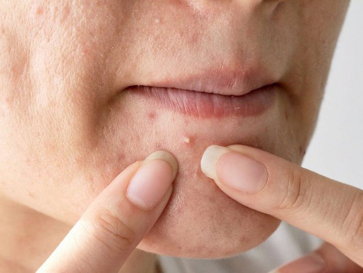 Nám da, da thâm do đâu và cách chăm sóc, điều trị - Ảnh 1.