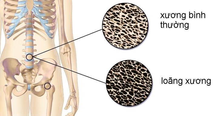 Kết quả đo mật độ xương như thế nào cần đáng lo? - Ảnh 1.