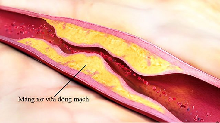 Cảnh giác với bệnh tắc nghẽn mạch máu não - Ảnh 2.