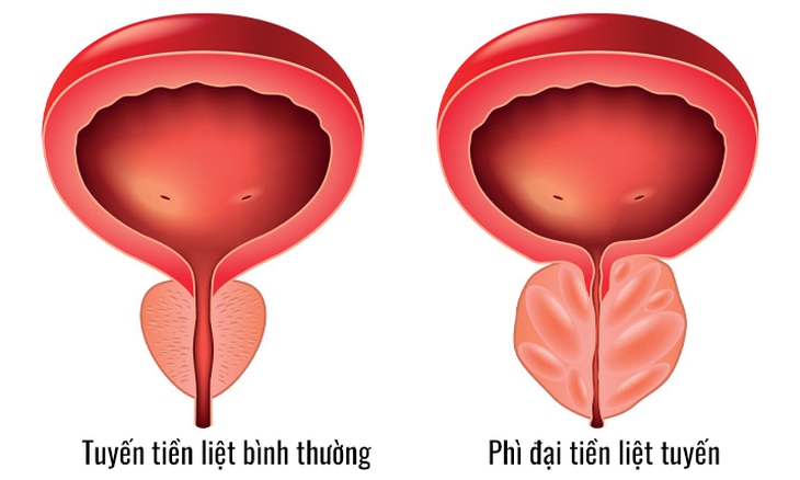 Phì đại tiền liệt tuyến có chữa được không? - Ảnh 3.