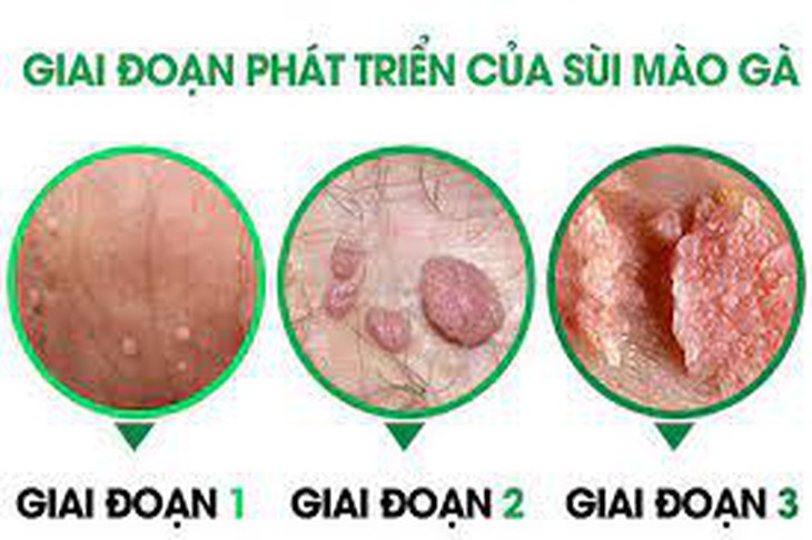 Mắc bệnh sùi mào gà có khả năng tiến triển thành ung thư không? - Ảnh 2.