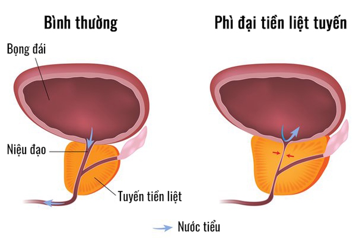 Phì đại tiền liệt tuyến có chữa được không? - Ảnh 2.