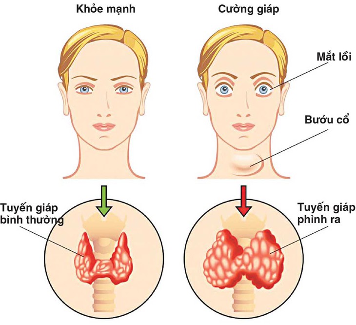 Bệnh lý tuyến giáp phổ biến nhưng ít có biểu hiện rõ ràng, dưới đây là 11 dấu hiệu cảnh báo liên quan đến căn bệnh này - Ảnh 2.
