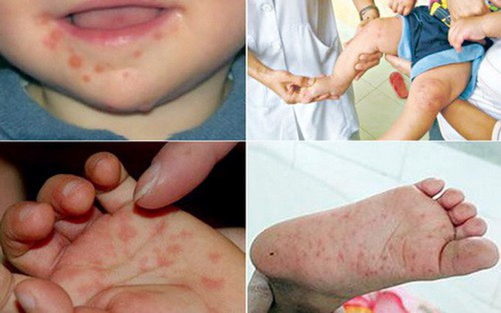 Có thuốc đặc hiệu điều trị bệnh tay chân miệng ở trẻ không?