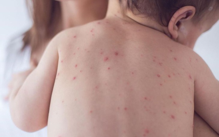 Lây thủy đậu từ mẹ, bé 27 ngày tuổi biến chứng nặng