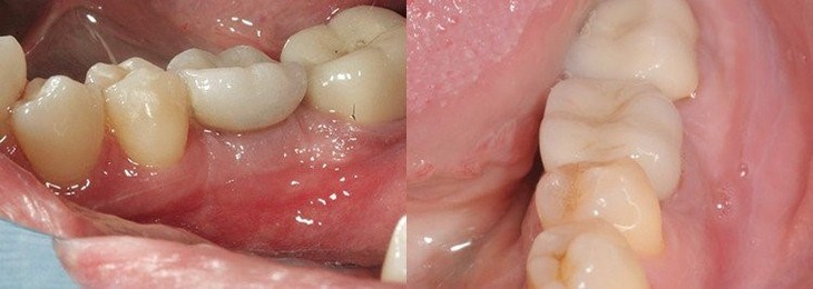 Ra mắt công nghệ phục hình răng sứ trên implant DCT - Ảnh 1.