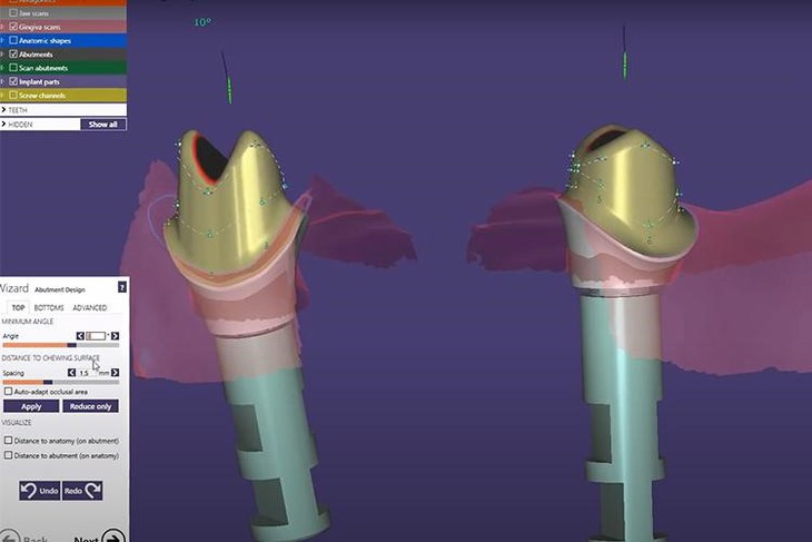 Ra mắt công nghệ phục hình răng sứ trên implant DCT - Ảnh 2.
