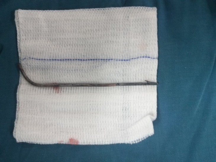 Nam thanh niên bị mũi tên bắn cá dài 10cm đâm xuyên vào tuỷ - Ảnh 1.