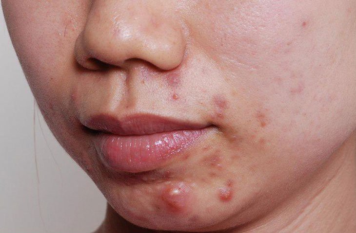 Vitamin nào hỗ trợ điều trị mụn trứng cá? - Ảnh 1.