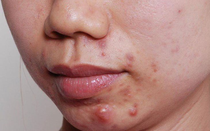 Các chất bổ sung hỗ trợ điều trị mụn trứng cá