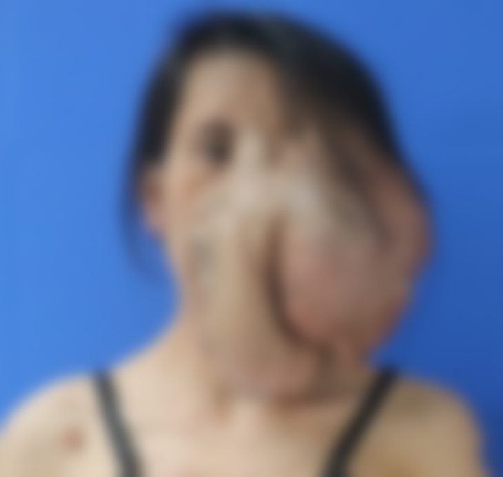 Người phụ nữ có khối u khổng lồ vùng mặt to như một chiếc đầu thứ hai - Ảnh 1. Người phụ nữ có khối u khổng lồ vùng mặt to như một chiếc đầu thứ hai - Ảnh 1.