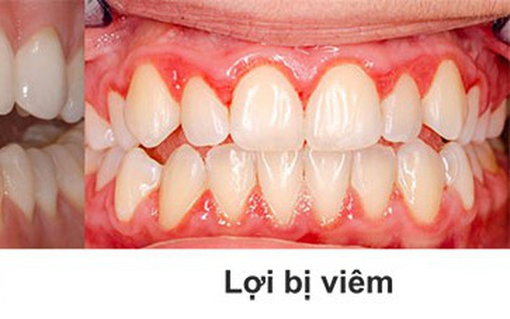 Viêm lợi: Nguyên nhân, biểu hiện và điều trị