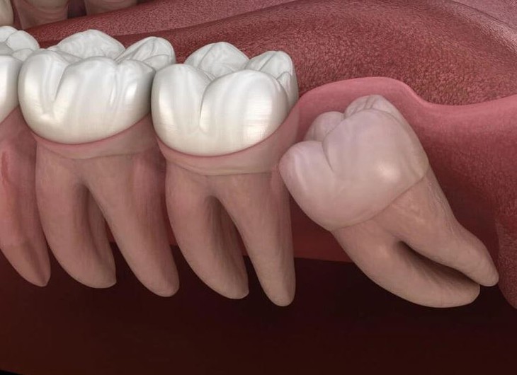 Răng mọc ngầm: Nguyên nhân, biểu hiện và điều trị - Ảnh 2.