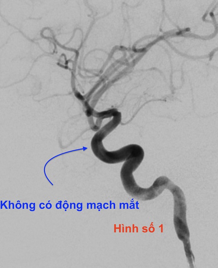 Tiêm filler thẩm mỹ tại sao lại mù mắt, chuyên gia chia sẻ để chị em làm đẹp cần nhớ - Ảnh 2. Tiêm filler thẩm mỹ tại sao lại mù mắt, chuyên gia chia sẻ để chị em làm đẹp cần nhớ - Ảnh 2.
