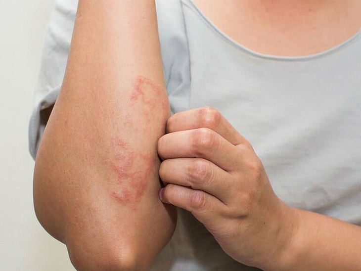 Đối phó với viêm da mủ khi thời tiết nóng nực - Ảnh 3.