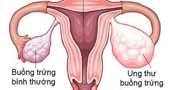 Dấu hiệu cảnh báo ung thư buồng trứng - Ảnh 2. Dấu hiệu cảnh báo ung thư buồng trứng - Ảnh 2.