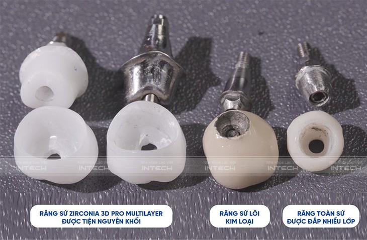 Ưu điểm vượt trội của công nghệ phục hình răng sứ trên implant DCT - Ảnh 2.