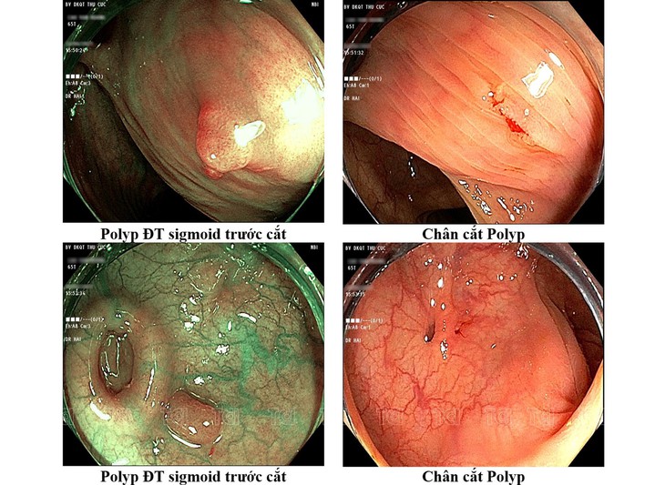 Nội soi dạ dày đại tràng - "Khắc tinh" số 1 của polyp đường tiêu hóa - Ảnh 1.