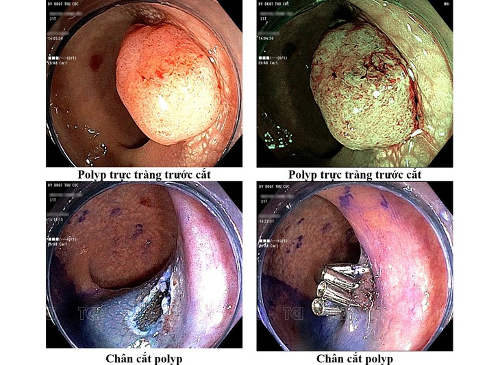 Nội soi dạ dày đại tràng - "Khắc tinh" số 1 của polyp đường tiêu hóa - Ảnh 3.