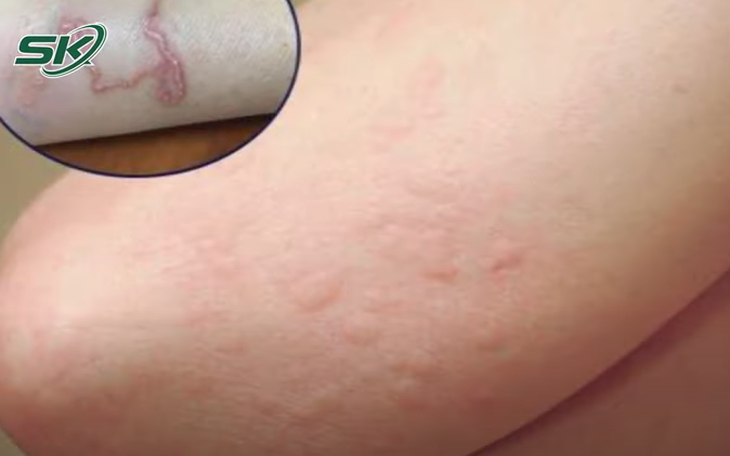 Ho dai dẳng do sán ký sinh khắp người