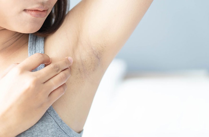 Cách nào cải thiện vùng da thâm sạm dưới cánh tay?- Ảnh 1.