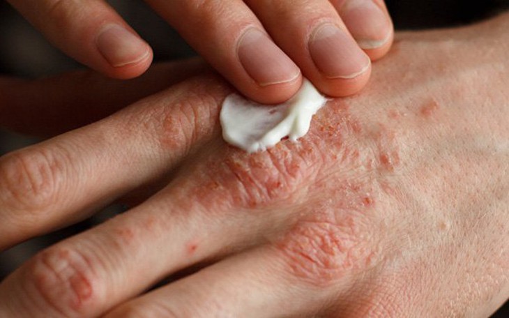 Phòng tránh và điều trị bệnh chàm