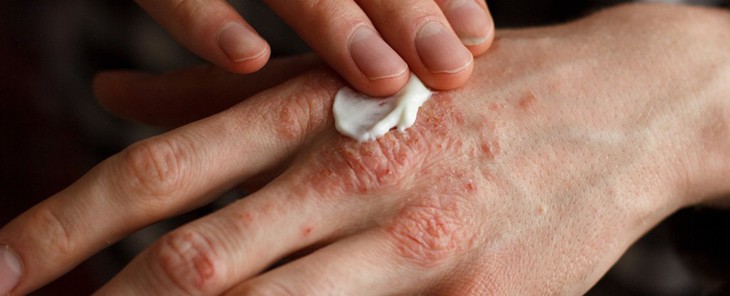 Bệnh chàm: Dấu hiệu, biến chứng và cách điều trị - Ảnh 1.