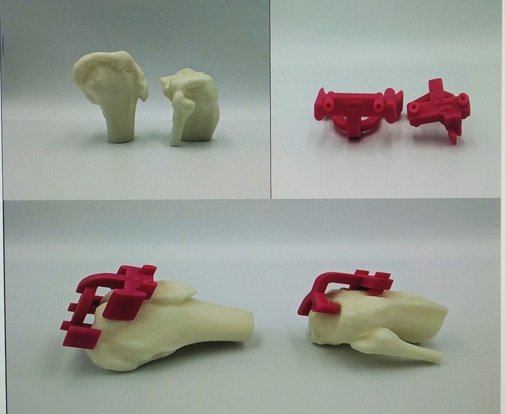 Đưa ứng dụng công nghệ in 3D vào phẫu thuật thay khớp gối - Ảnh 4. Đưa ứng dụng công nghệ in 3D vào phẫu thuật thay khớp gối - Ảnh 4.