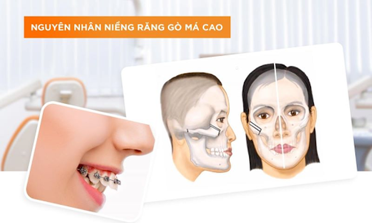 Niềng răng bị hóp má: Chuyên gia chỉ ra 3 nguyên nhân chính và 2 cách khắc phục đơn giản, hiệu quả - Ảnh 1.