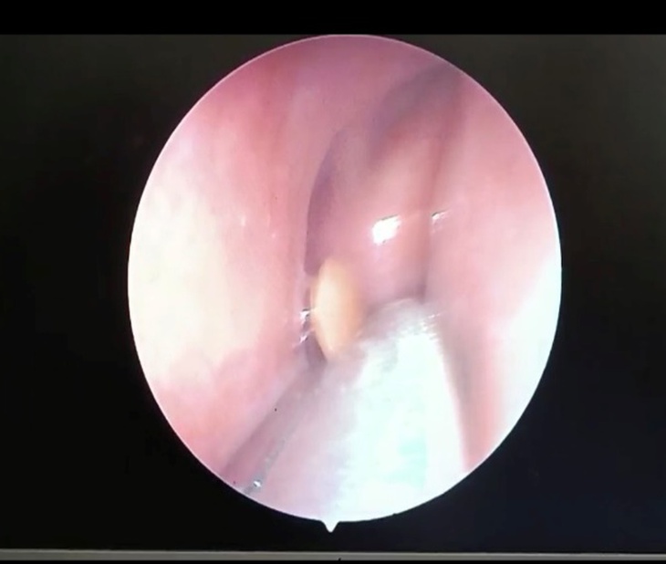 Con Vắt dài gần 3cm trong mũi bệnh nhân - Ảnh 1.