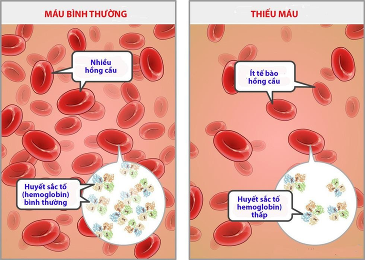 Tại sao thiếu máu dinh dưỡng ngoài bổ sung sắt lại cần thêm kẽm? - Ảnh 3.