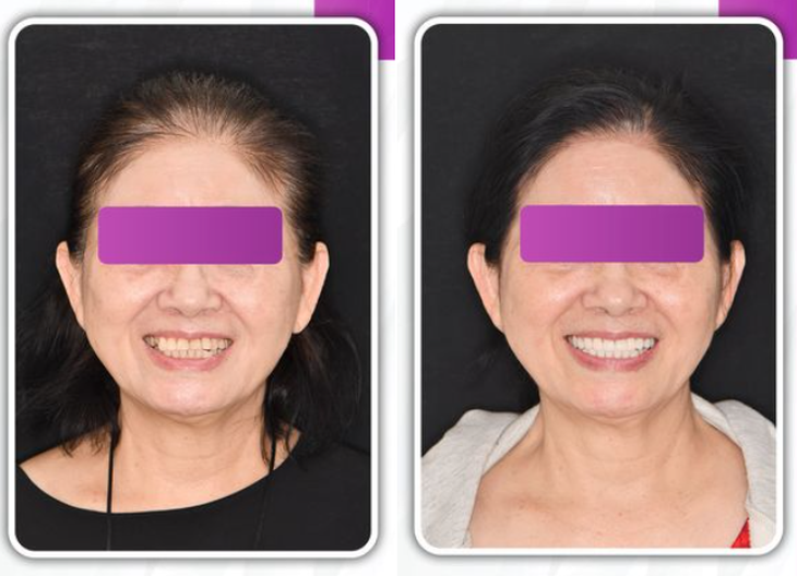 Quy trình dán sứ Veneer với bác sĩ giỏi - Ảnh 3.