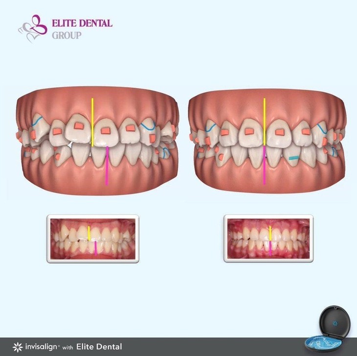 Niềng răng trong suốt: Yếu tố nào quyết định? - Ảnh 3. Niềng răng trong suốt: Yếu tố nào quyết định? - Ảnh 3.