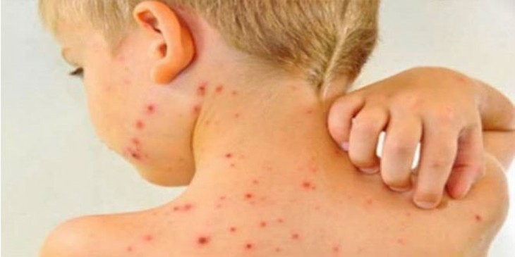 Điều trị chốc lở ở trẻ - Ảnh 1. Điều trị chốc lở ở trẻ - Ảnh 1.