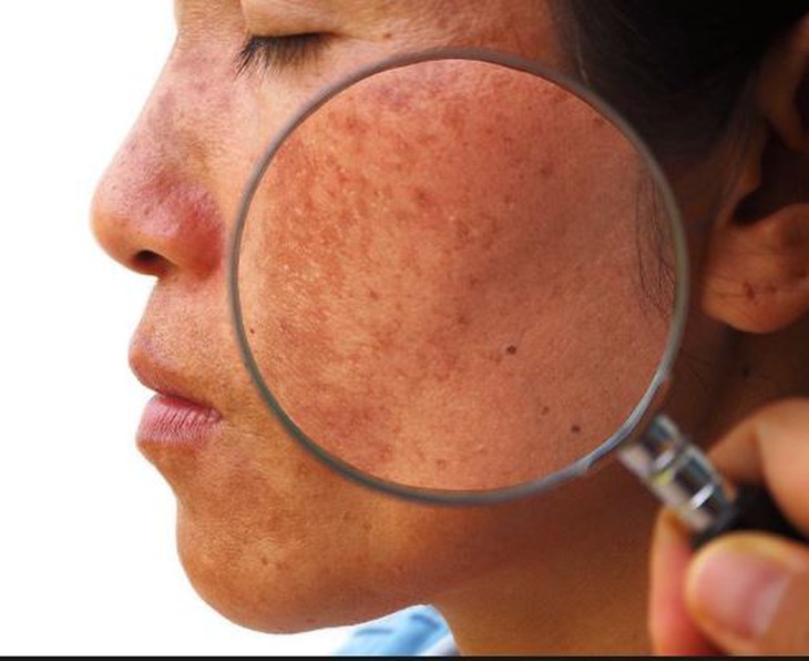 Bệnh nám da mùa hè, phòng và điều trị hiệu quả cần nhớ - Ảnh 1.