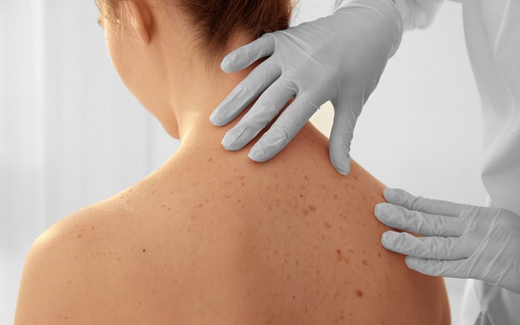 Các yếu tố gây ung thư da và cách phòng ngừa