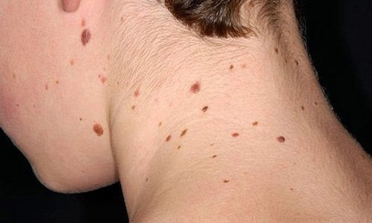 Hầu hết các bệnh ung thư da đều có thể phòng ngừa được.