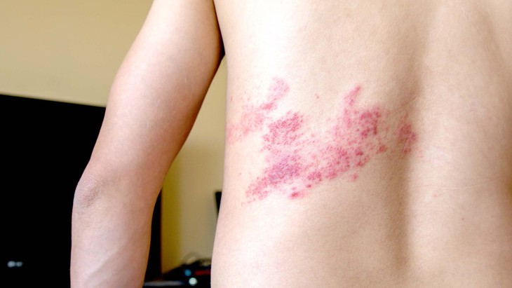 Bệnh zona dễ nhầm lẫn với căn bệnh nào? - Ảnh 2.