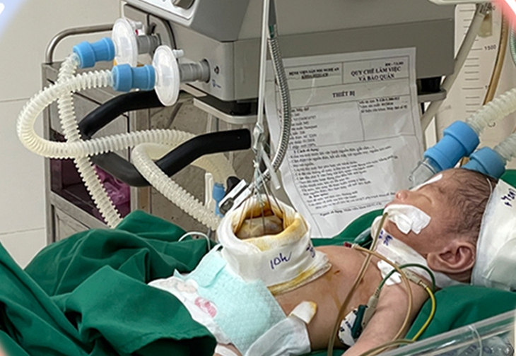 Cứu sống trẻ sơ sinh bị thoát vị cuống rốn phức tạp - Ảnh 1.