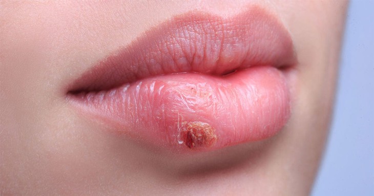 Herpes có chữa khỏi được không? - Ảnh 2.