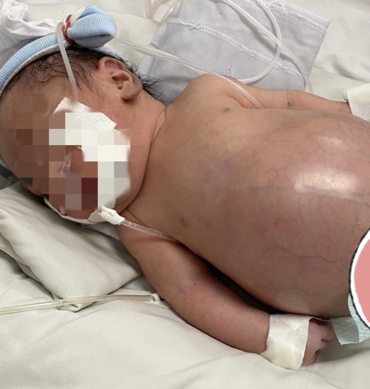 Cứu trẻ sơ sinh vừa chào đời đã phải lên bàn mổ - Ảnh 2.