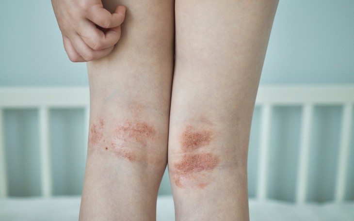 Những lưu ý cho người viêm da cơ địa khi trời nắng nóng